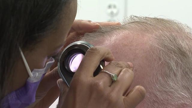 A doctor uses a magnifying glass with a light to check for skin cancer on a man's head. 